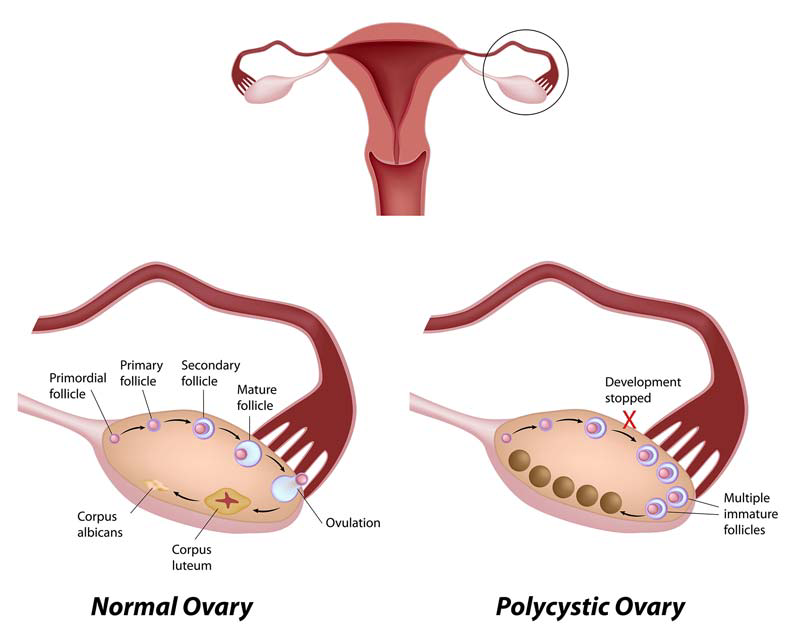 PCOS i in vitro