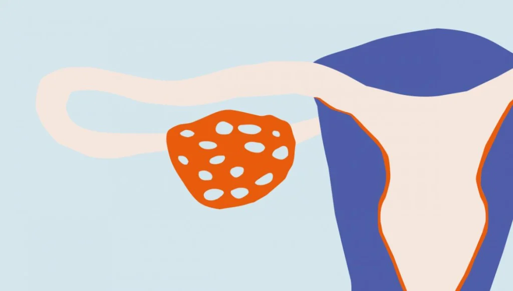 Poor ovarian reserve and IVF